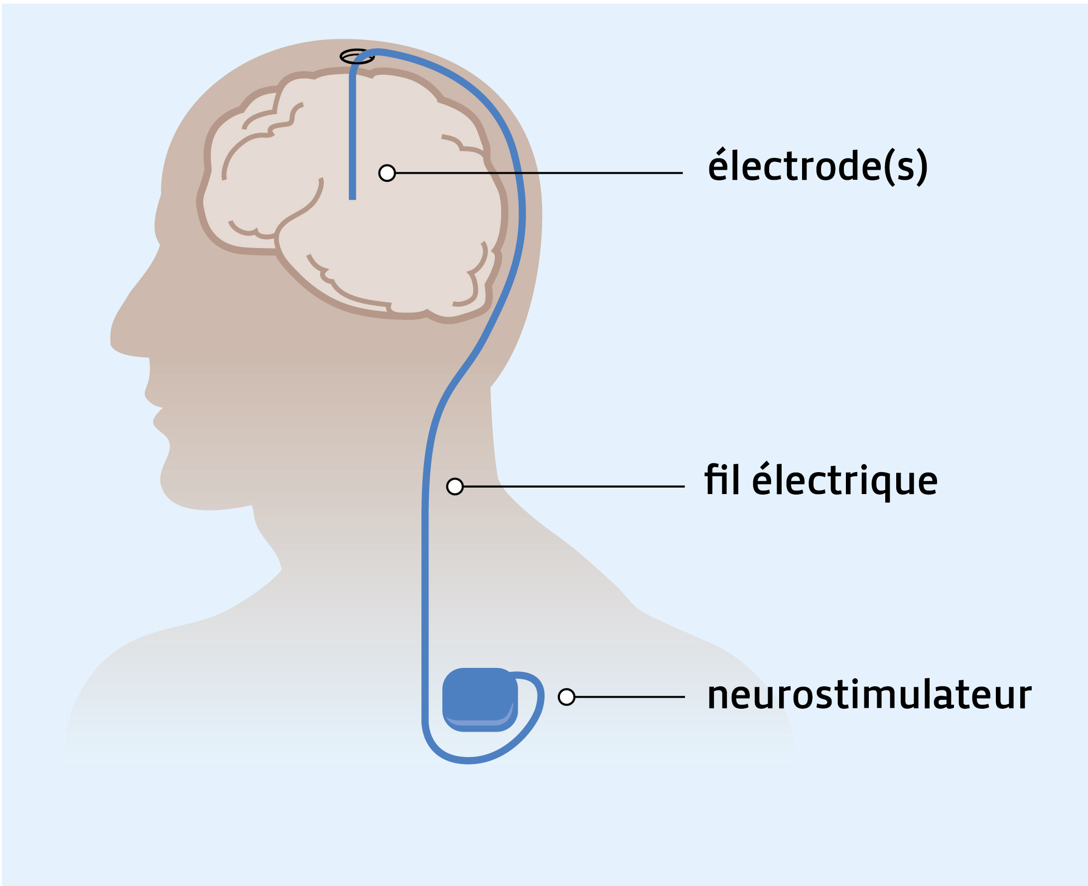 Stimulation cérébrale profonde